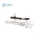 Penning Wrist Fixator(PEEK) For Distal Radius Fragment Orthofix Types External Fixation System