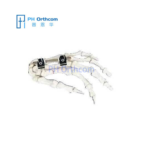 Lengthening Penning MiniFixator Orthofix Type Mini Fragment External Fixator Trauma Orthopedic-0 Lengthening Penning MiniFixator Orthofix Type Mini Fragment External Fixator Trauma Orthopedic