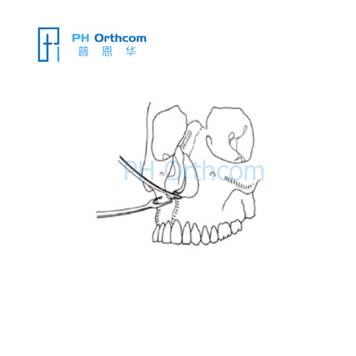 Instrument For The Cranio-Maxillofacial Surgery Orthopaedic Instrument Nasal Septum Osteotomes-1 Instrument For The Cranio-Maxillofacial Surgery Orthopaedic Instrument Nasal Septum Osteotomes