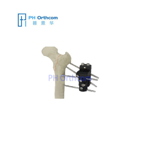 Pertrochanteric Fixator For Femoral Fracture OrthoFix Type External Fixators Trauma Orthopaedic